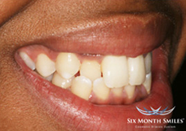Six Months Smiles