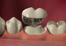 dental crowns