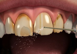 porcelain veneers