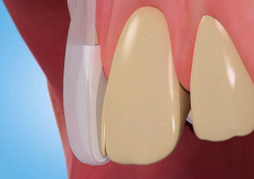 Stained Discoloured Teeth